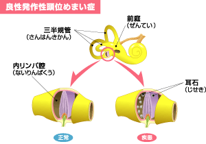 と は うい めまい 症 と